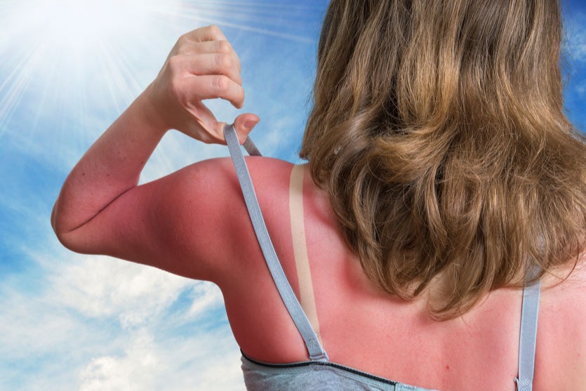 6 Cara Mengatasi Sunburn Dengan Cepat Dan Alami Tanpa Membuat Kulit Merah Womantalk