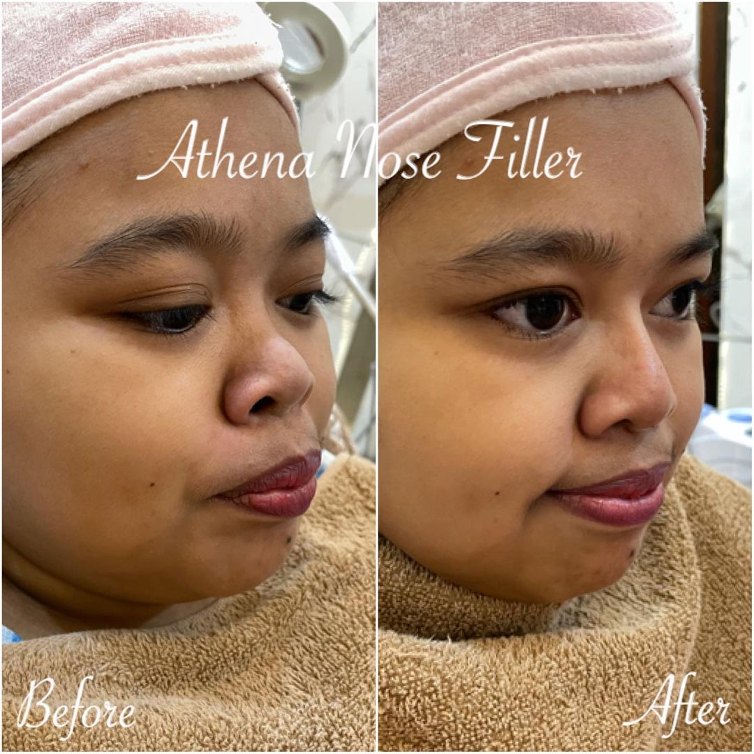 Apa Itu Filler Hidung Yang Dilakukan Kekeyi Dan Bikin Penampilannya Berubah Womantalk