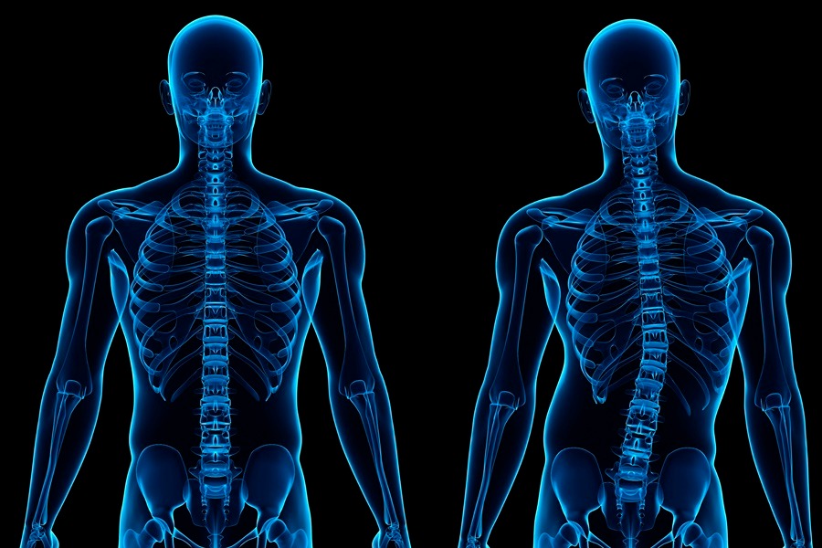 Tulang Leher Bengkok Info Tips