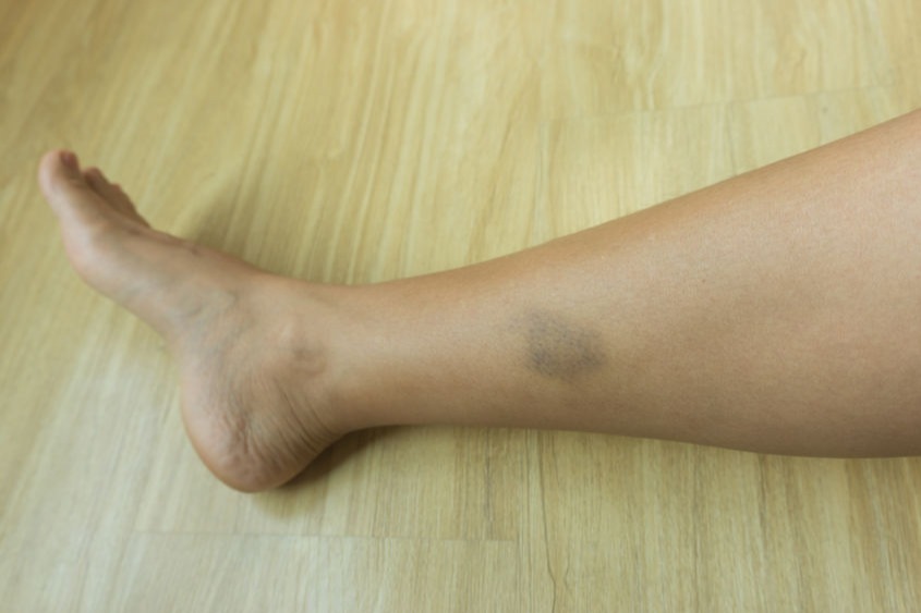 6 Penyebab Umum Tubuh Lebam Tiba Tiba Bukan Karena Dicubit Setan Womantalk